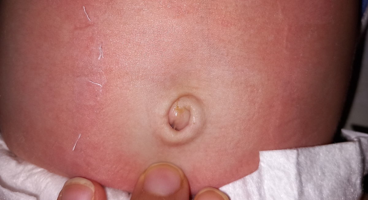 عفونت ناف در یکماهگی عفونت ناف در یکماهگی