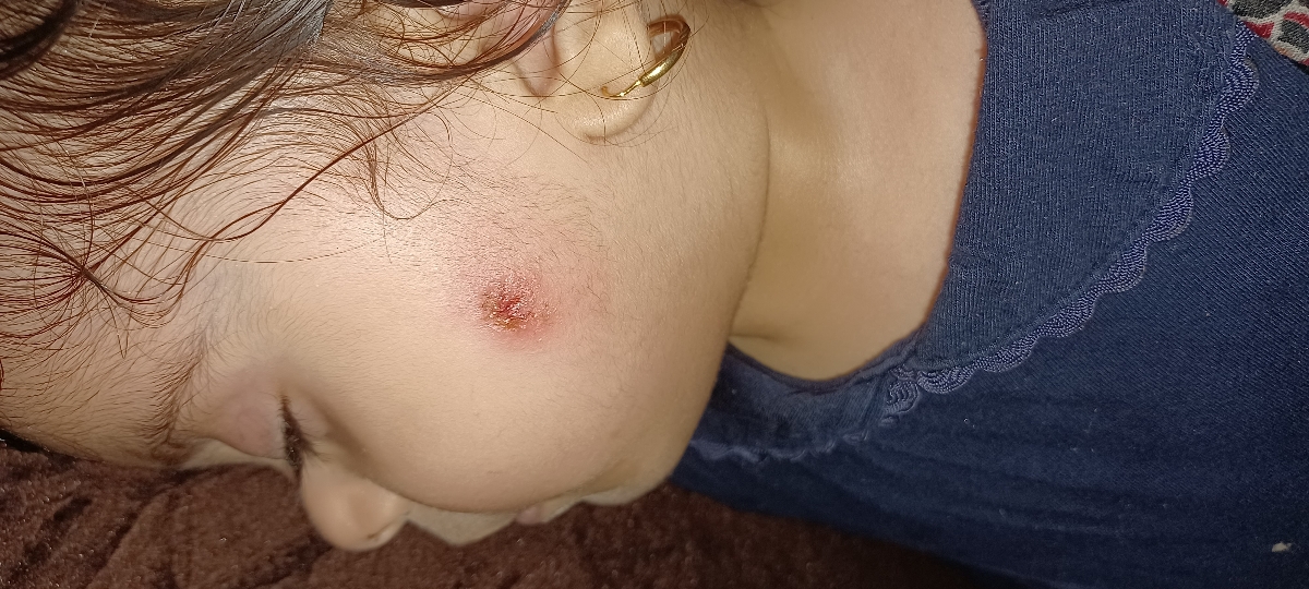 زخم شدن صورت بچم چیکار کنم خوب شه