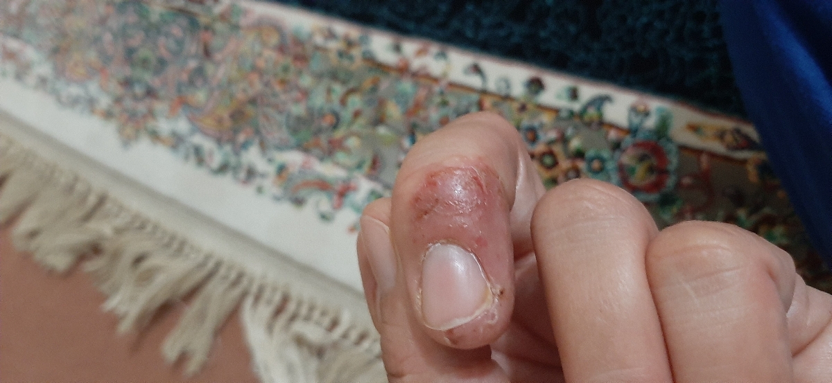 اگزمای شدید مقاوم به درمان هر دو دست و داخل بینی و روش مطمئن درمان اگزمای شدید مقاوم به درمان هر دو دست و داخل بینی و روش مطمئن درمان