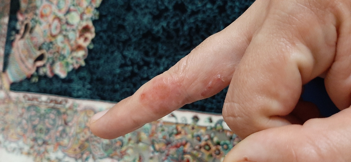 اگزمای شدید مقاوم به درمان هر دو دست و داخل بینی و روش مطمئن درمان اگزمای شدید مقاوم به درمان هر دو دست و داخل بینی و روش مطمئن درمان