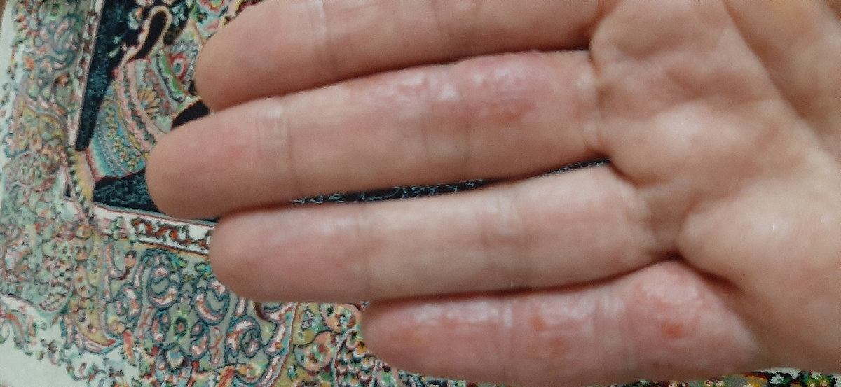 اگزمای شدید مقاوم به درمان هر دو دست و داخل بینی و روش مطمئن درمان اگزمای شدید مقاوم به درمان هر دو دست و داخل بینی و روش مطمئن درمان