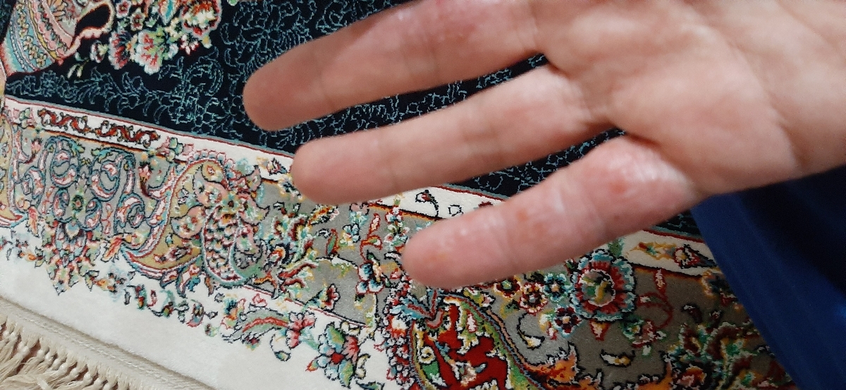 اگزمای شدید مقاوم به درمان هر دو دست و داخل بینی و روش مطمئن درمان اگزمای شدید مقاوم به درمان هر دو دست و داخل بینی و روش مطمئن درمان