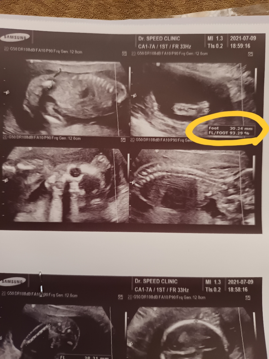 تفسیر سونو آنومالی تفسیر سونو آنومالی