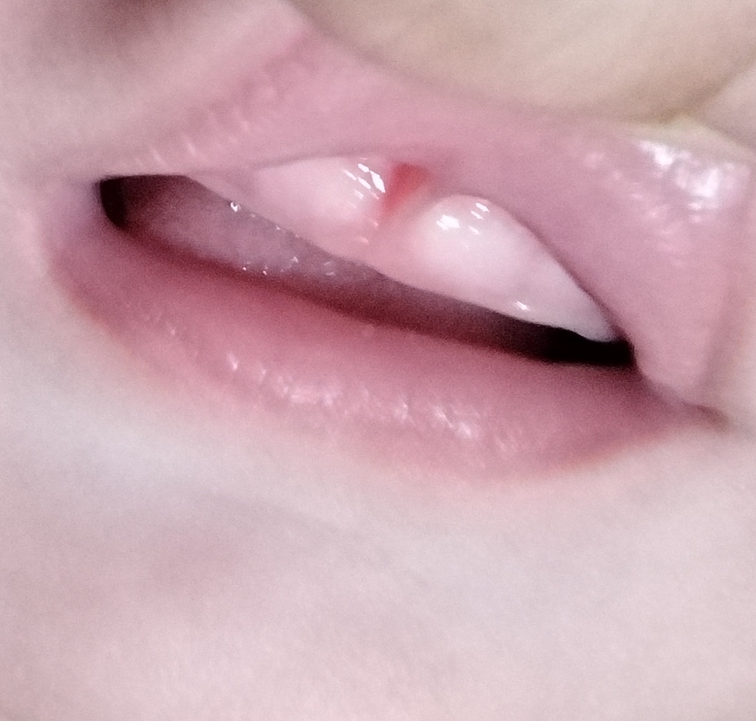 اینم عکس از لثه