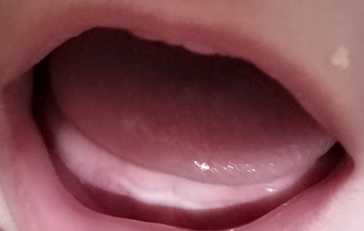 شیشه نگرفتن نوزاد 5 ماهه