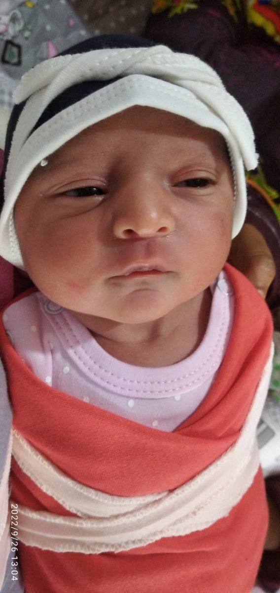 کوچک بودن چشم دوقلوهام کوچک بودن چشم دوقلوهام