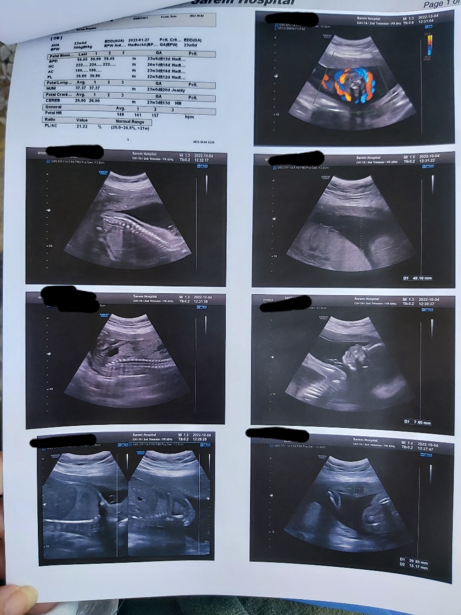 تفسیر سونو آنومالی در ۲۴ هفته تفسیر سونو آنومالی در ۲۴ هفته