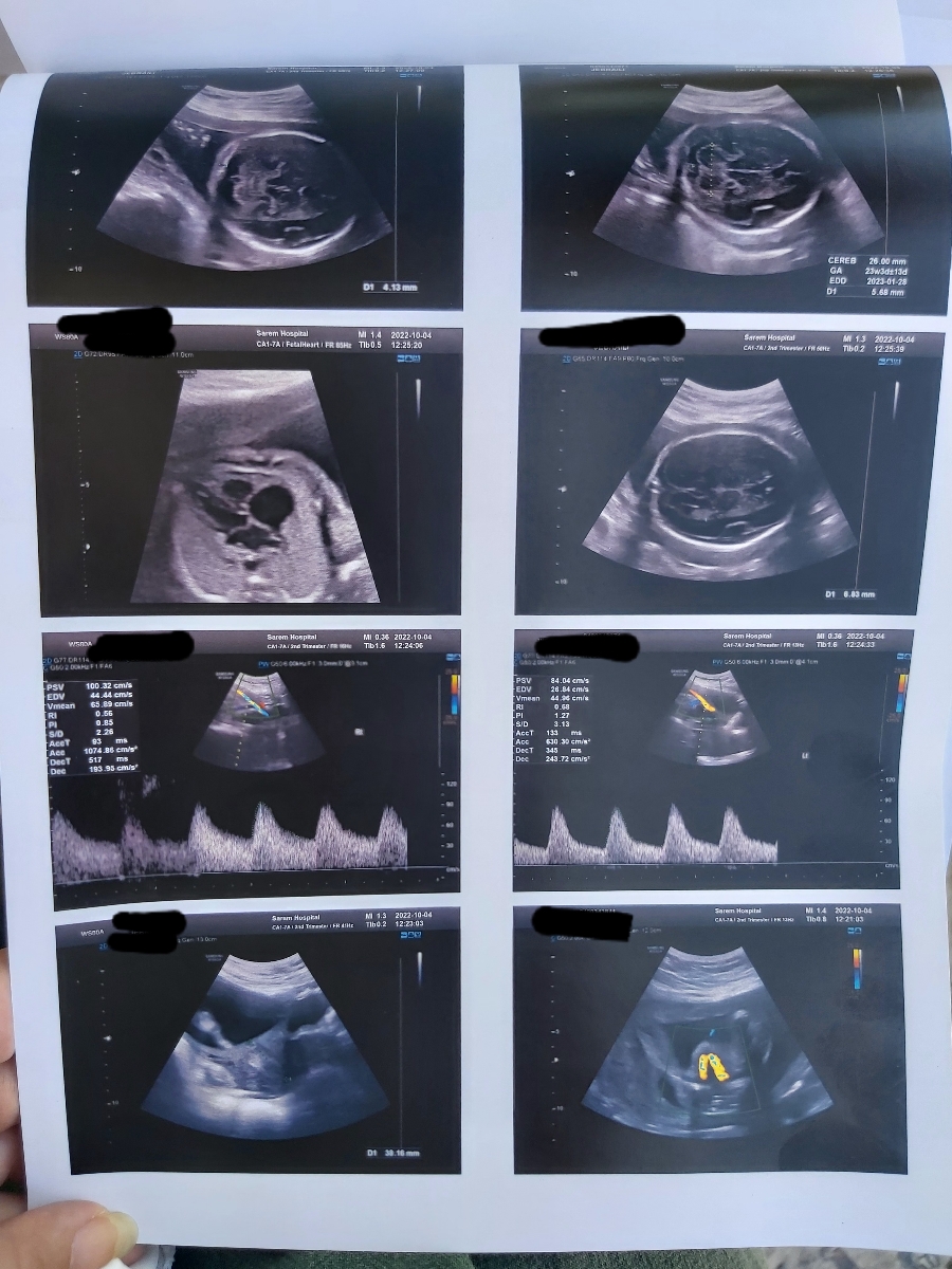 تفسیر سونو آنومالی در ۲۴ هفته تفسیر سونو آنومالی در ۲۴ هفته