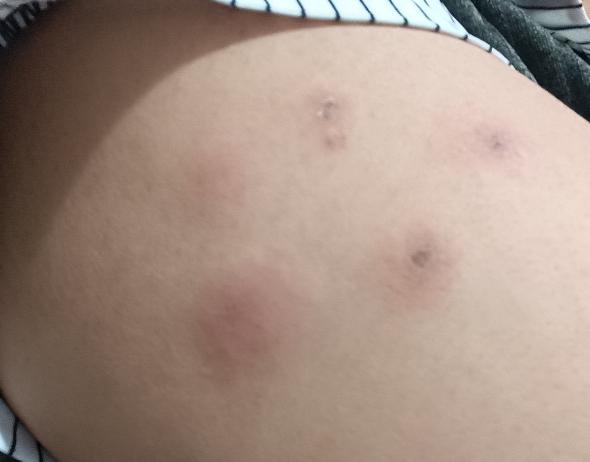 قرمز شدن و ورم کردن محل تزریق آنوکساپارین