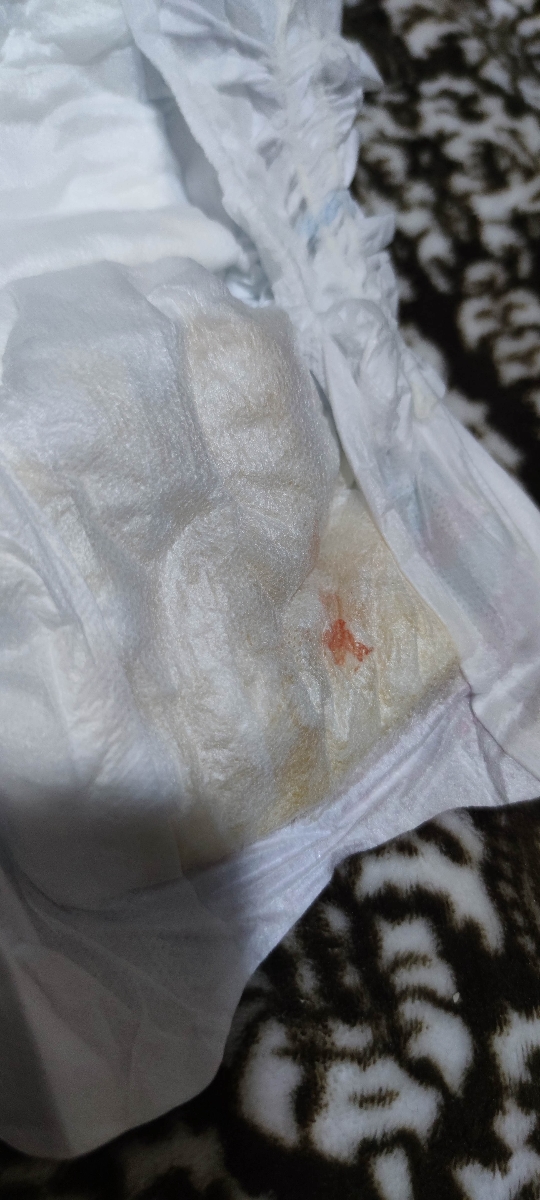 لکه خونی در پوشک نوزاد لکه خونی در پوشک نوزاد