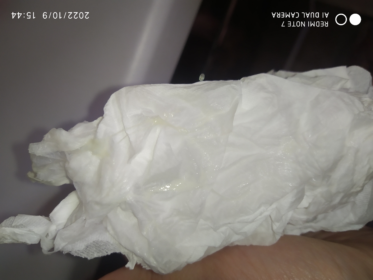 خیلی ببخشید این ترشحات من هست ولی زیاد ولی انگار ترشحات مایع مانند و شفاف که کمی حالت کشسان دارد را هم بینشون دارم یعنی دستمال خیس میشود یا گاهی لباس زیرم خیس میشود . خیلی ببخشید این ترشحات من هست ولی زیاد ولی انگار ترشحات مایع مانند و شفاف که کمی حالت کشسان دارد را هم بینشون دارم یعنی دستمال خیس میشود یا گاهی لباس زیرم خیس میشود .