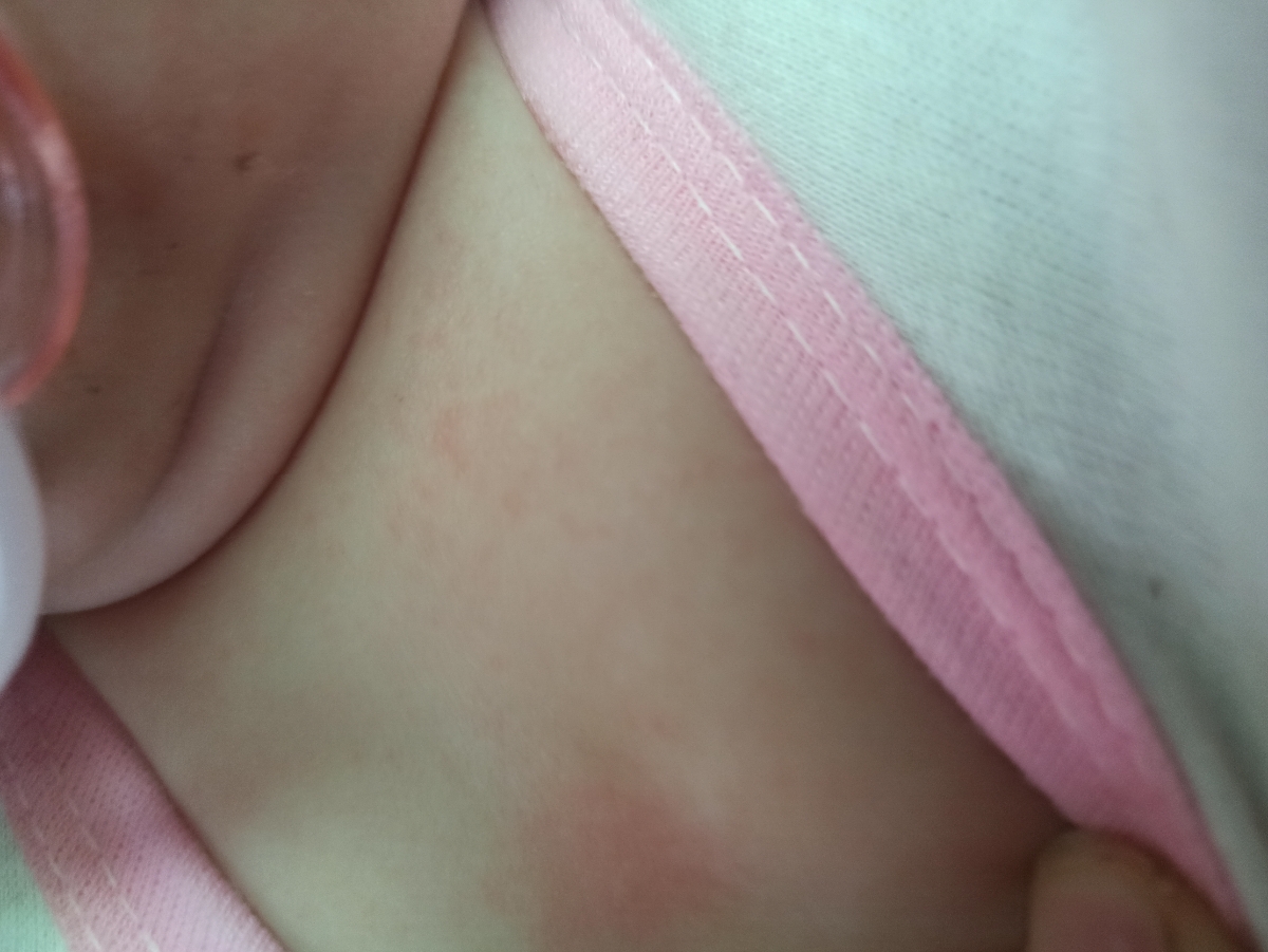 دونه های ریزاطراف گردن دونه های ریزاطراف گردن