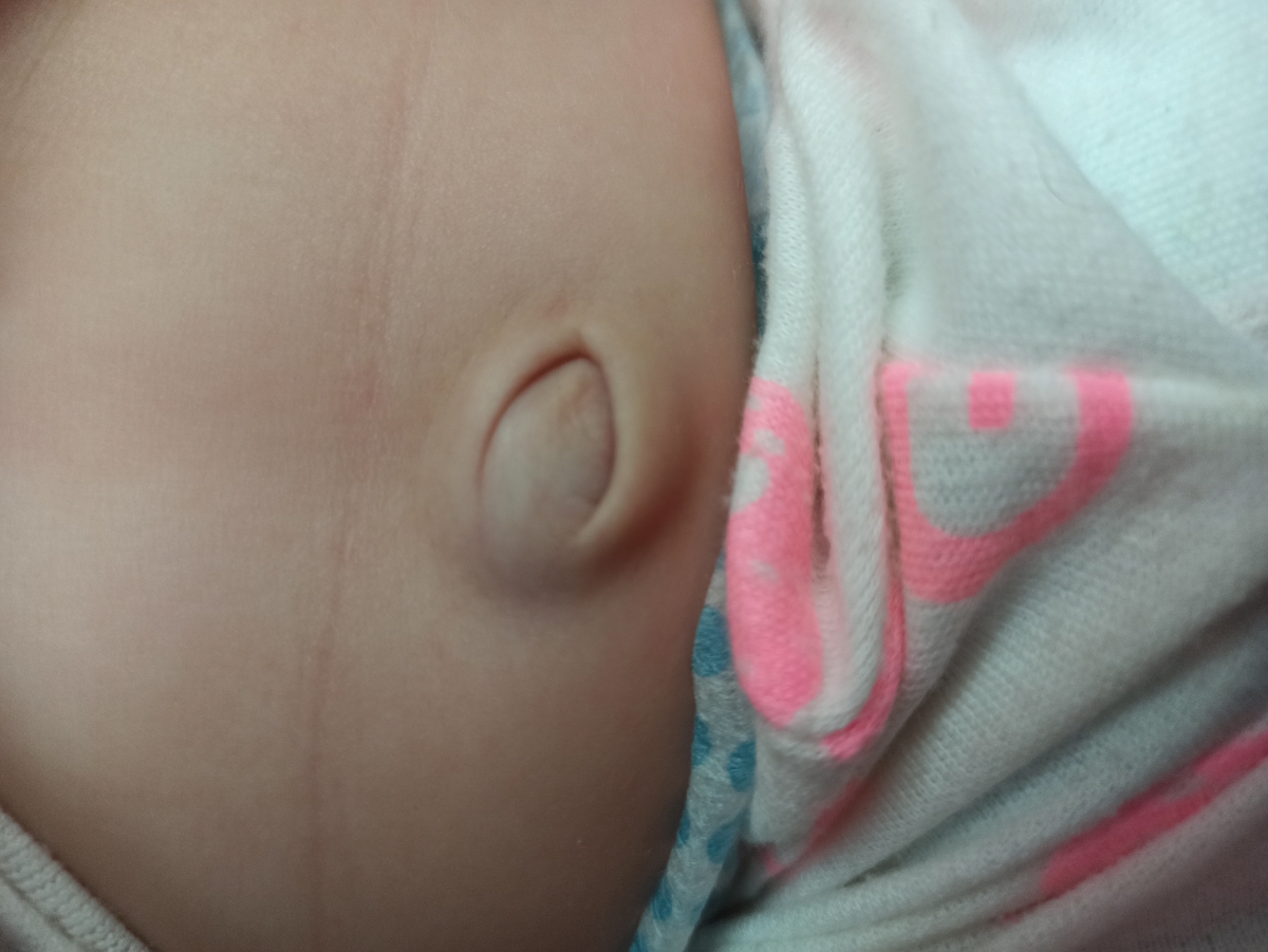 نافشم یکم زده بیرون حالت کبودشده نافشم یکم زده بیرون حالت کبودشده