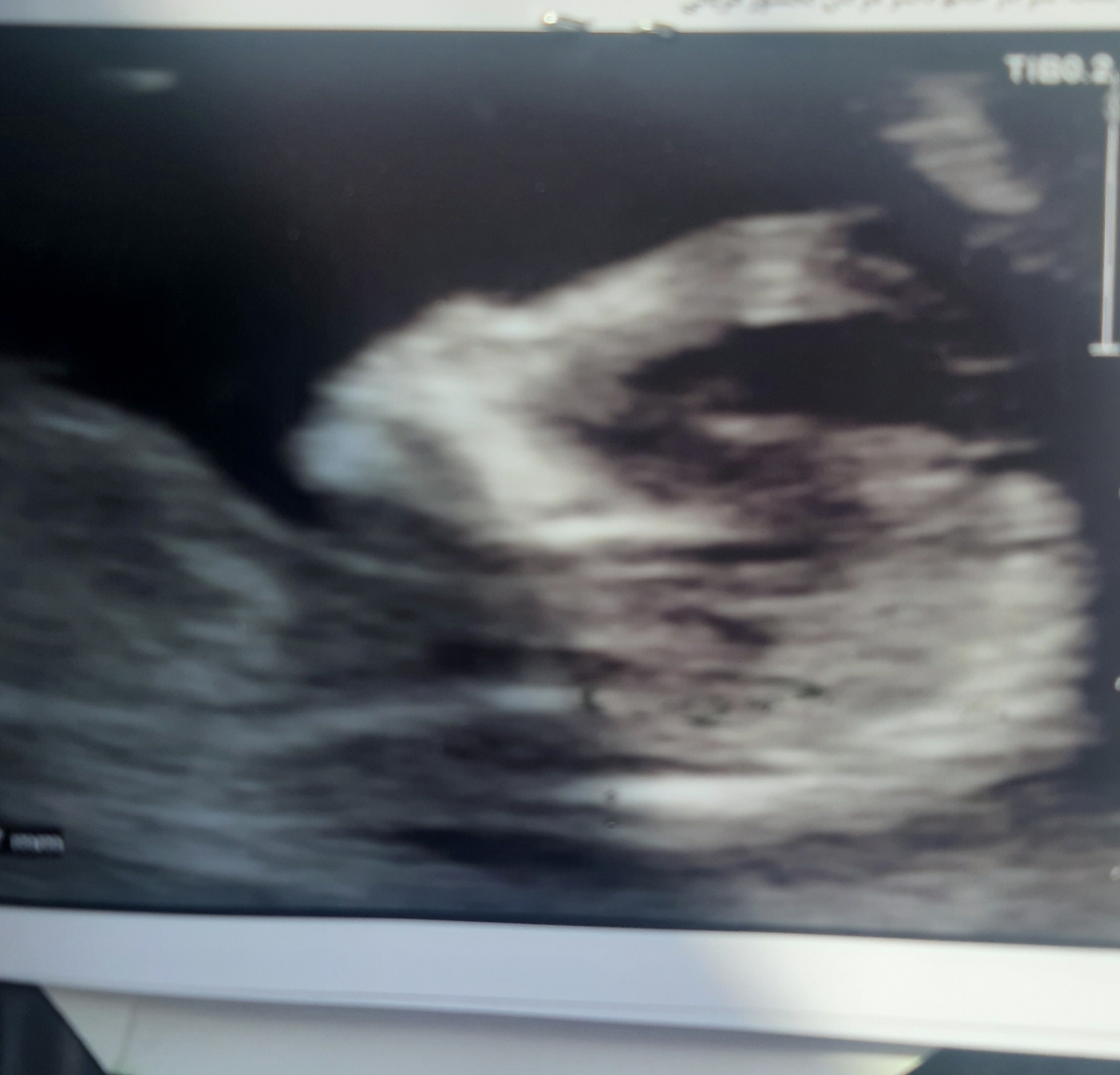 تشخیص جنسیت از روی سونو ان تی