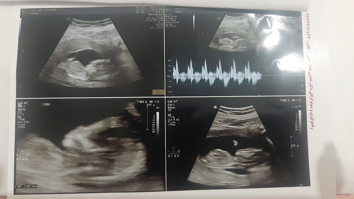 تشخیص جنسیت از روی سونو ان تی