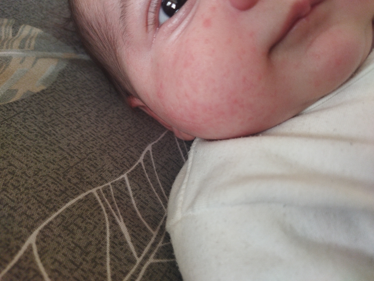 جوشای ریز رو صورت نوزاد یک ماهه؟