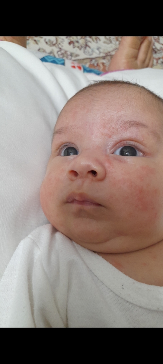 جوشای ریز رو صورت نوزاد یک ماهه؟