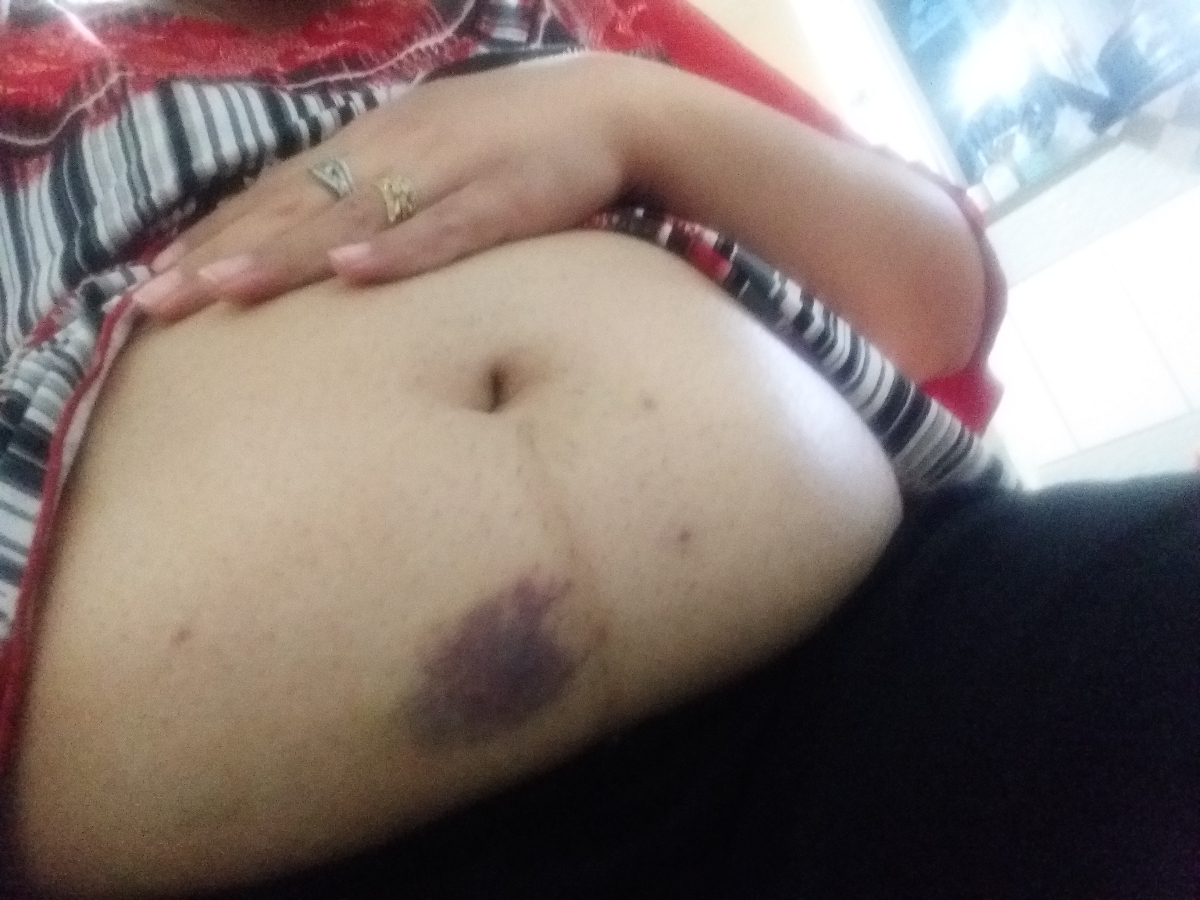 سفت شدن و تورم جای آمپول هپارین