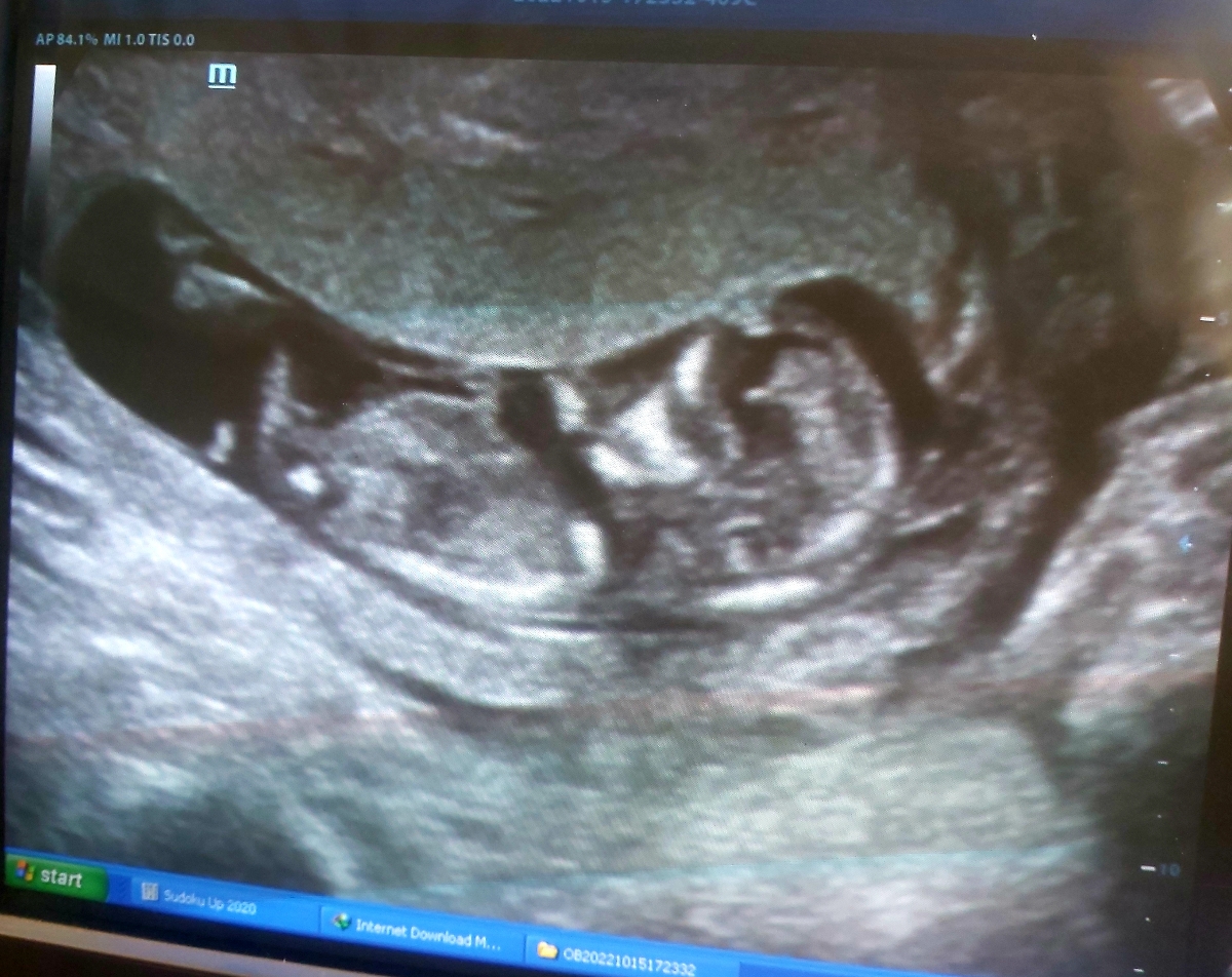 خانوما هرکسی بلده بیاد سونوNTمنو تفسیر کنه