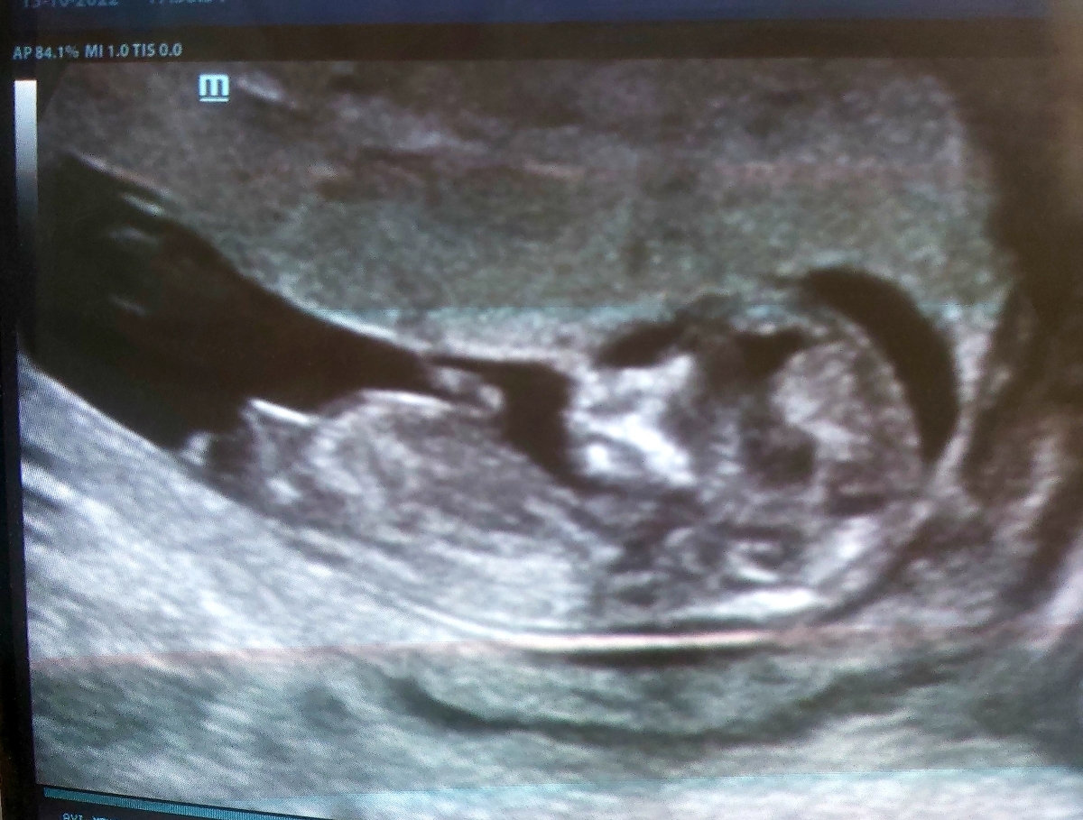 خانوما هرکسی بلده بیاد سونوNTمنو تفسیر کنه