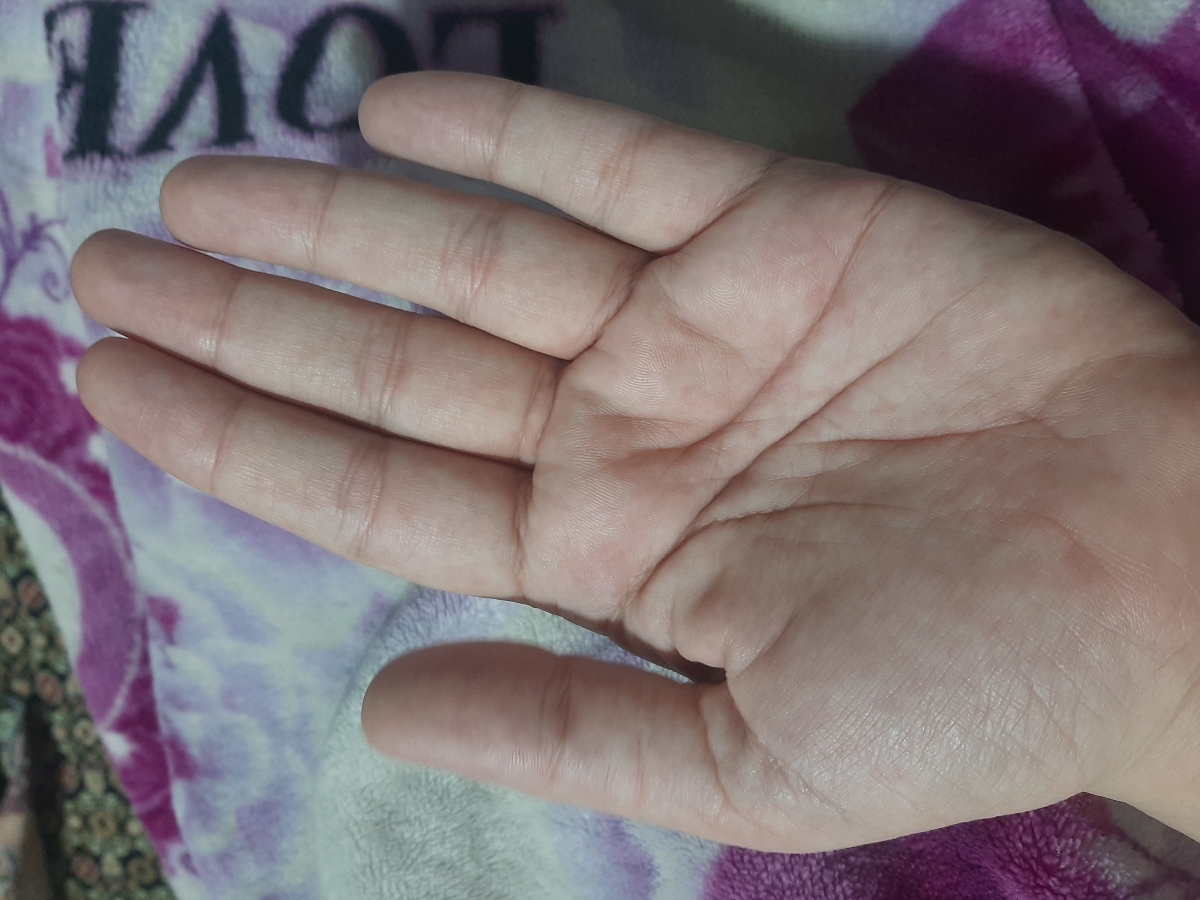 ورم و گزگز انگشتان دست ورم و گزگز انگشتان دست