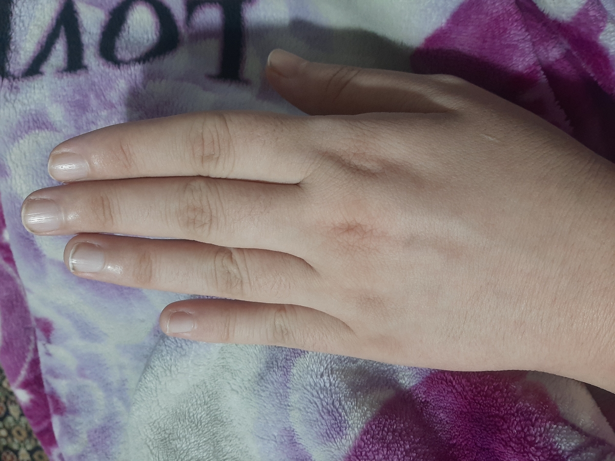 ورم و گزگز انگشتان دست ورم و گزگز انگشتان دست