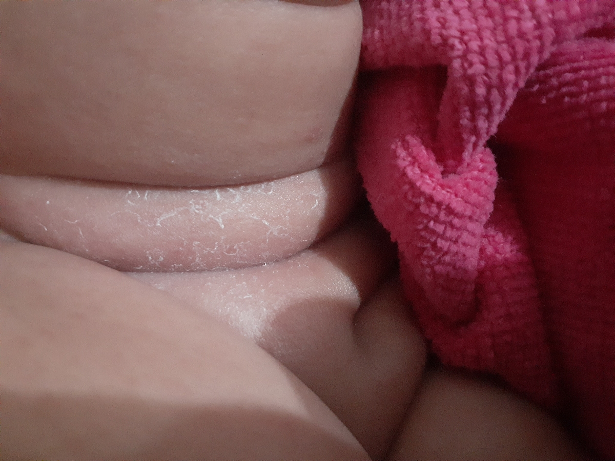 خشکی یا قارچ‌ زدن نوزاد