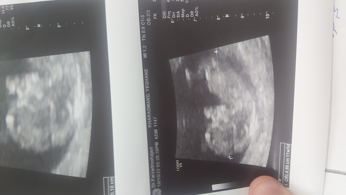 سونو انتی و ننوشتن طول سرویکس سونو انتی و ننوشتن طول سرویکس