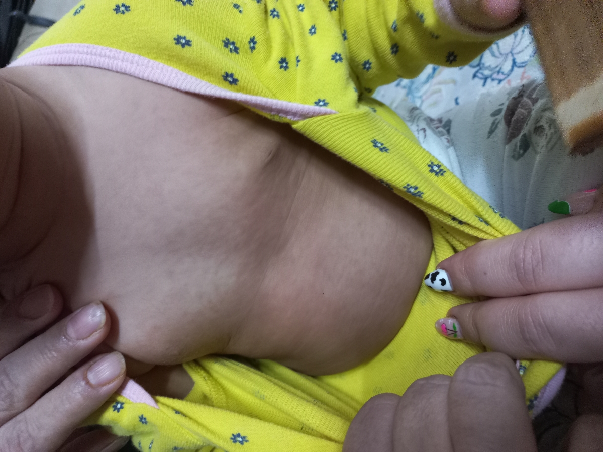 دونه های قرمز رو کل بدن بچه ۹ ماهه دونه های قرمز رو کل بدن بچه ۹ ماهه