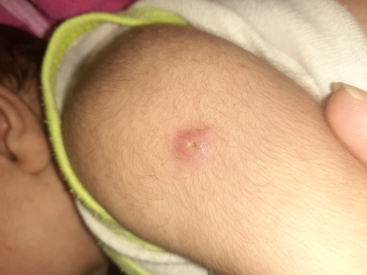 جوش چرکی سفید جای واکسن