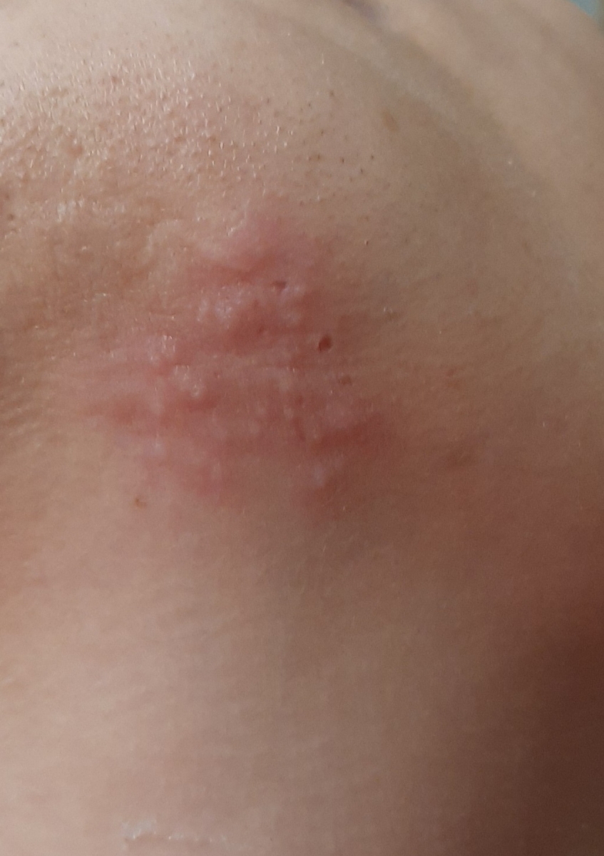 تبخال در بارداری ؟ تبخال در بارداری ؟