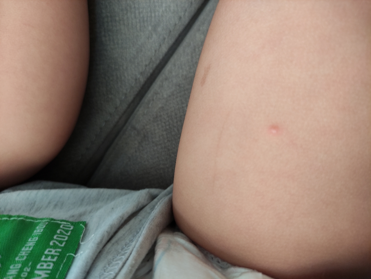 دونهای روی پای پسرم چیه دکتر جان دونهای روی پای پسرم چیه دکتر جان