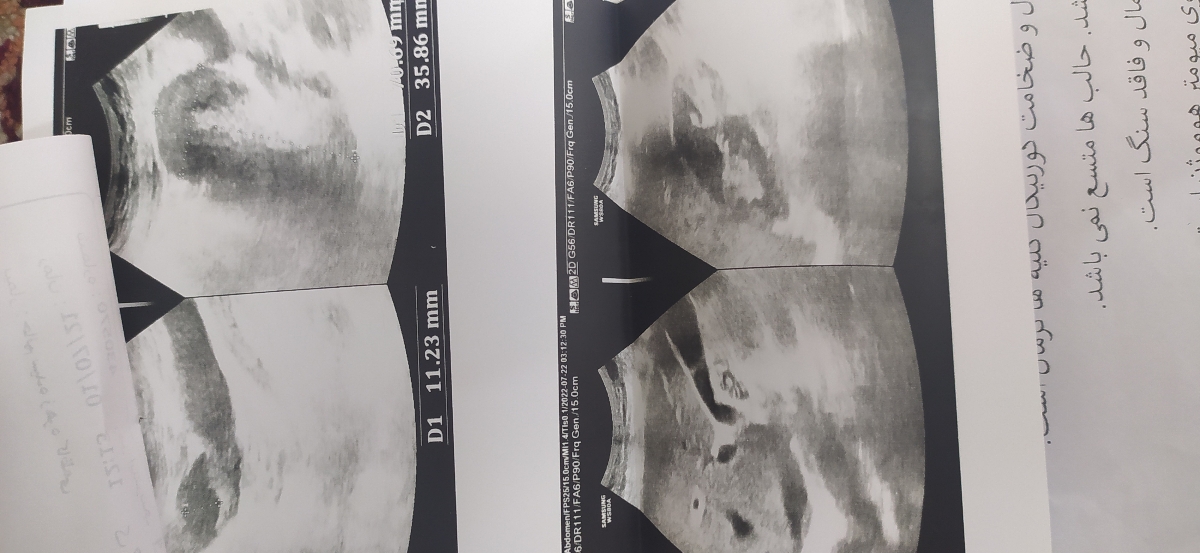 بررسی سونو گرافی شکم بررسی سونو گرافی شکم