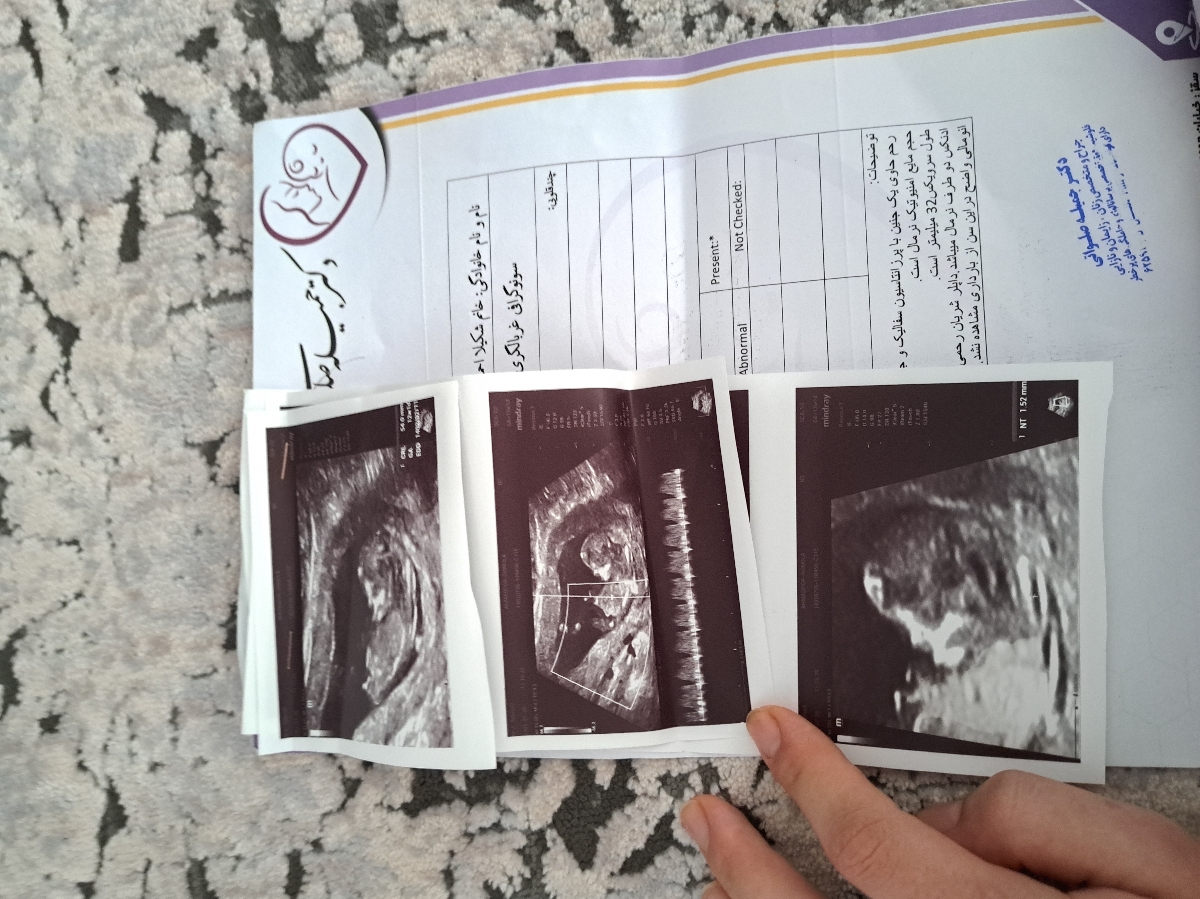 تفسیر جواب ازمایش و سونوگرافی غربالگری اول