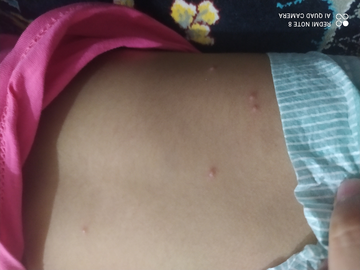 جوش زدن بدن کودک یک و نیم ساله