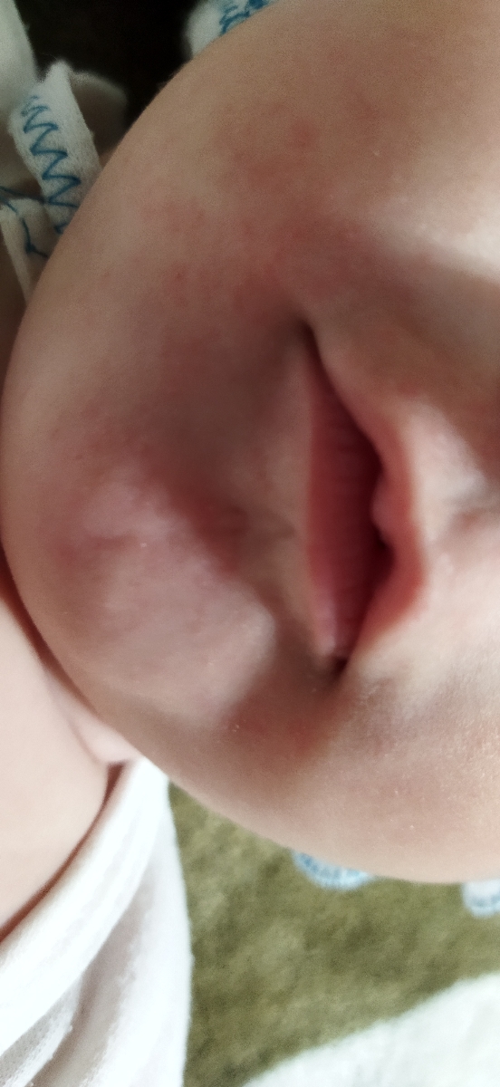 دونه های قرمز اطراف دهان و چونه