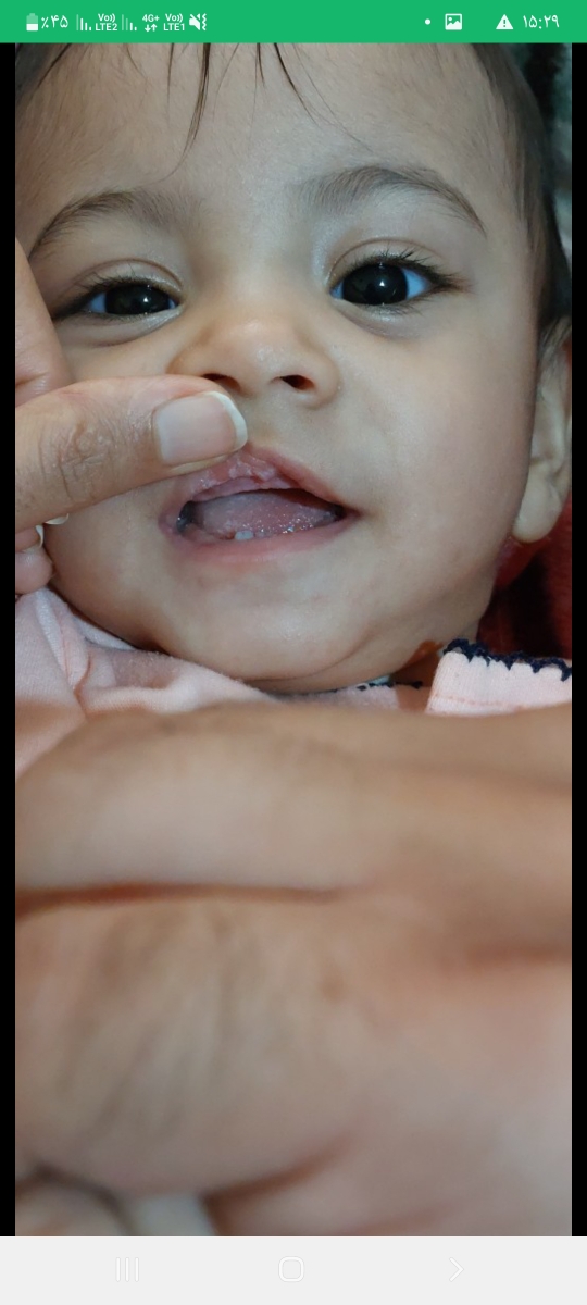 برفک زدن دهان نوزاد