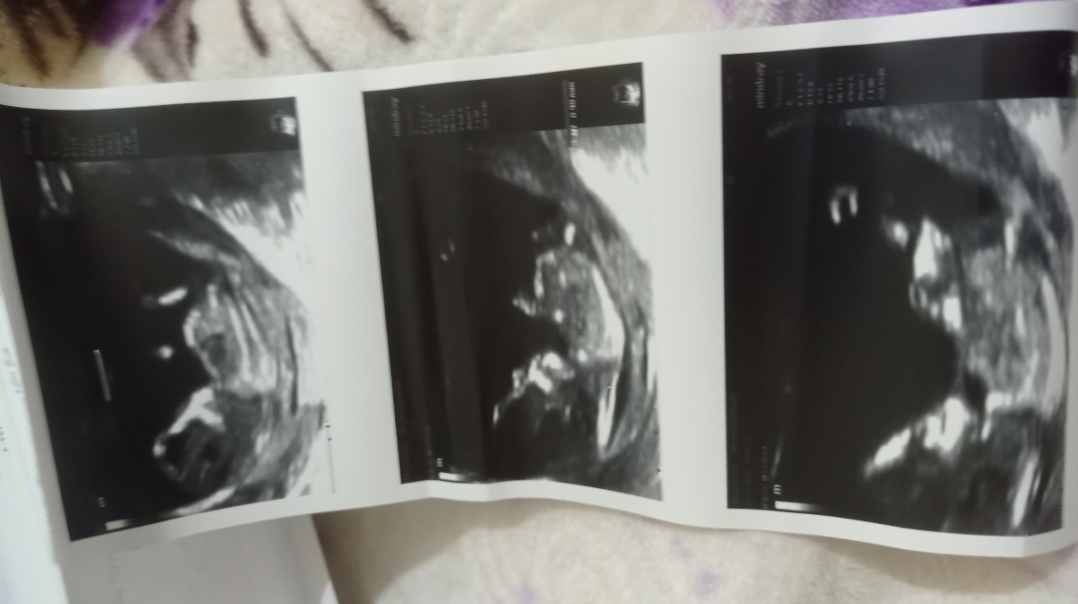 اینم عکس جنین جنسیت تشخیص داده میشه خانوم دکتر؟