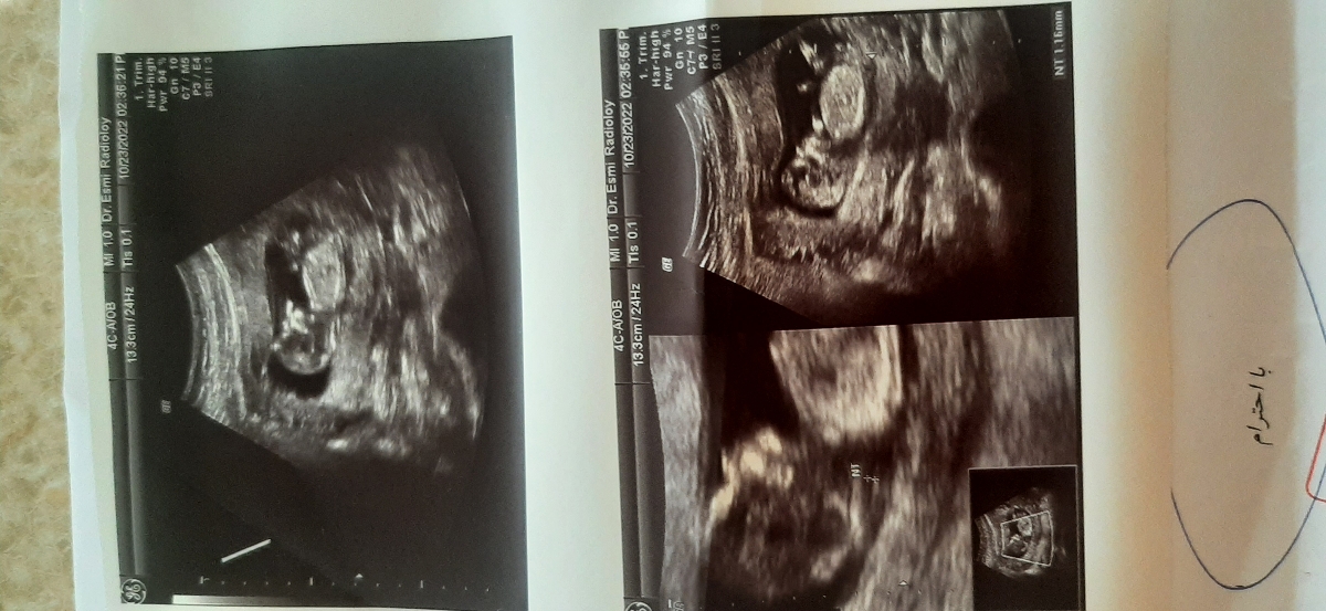 تفسیر سونو nt،تعیین جنسیت؟ تفسیر سونو nt،تعیین جنسیت؟