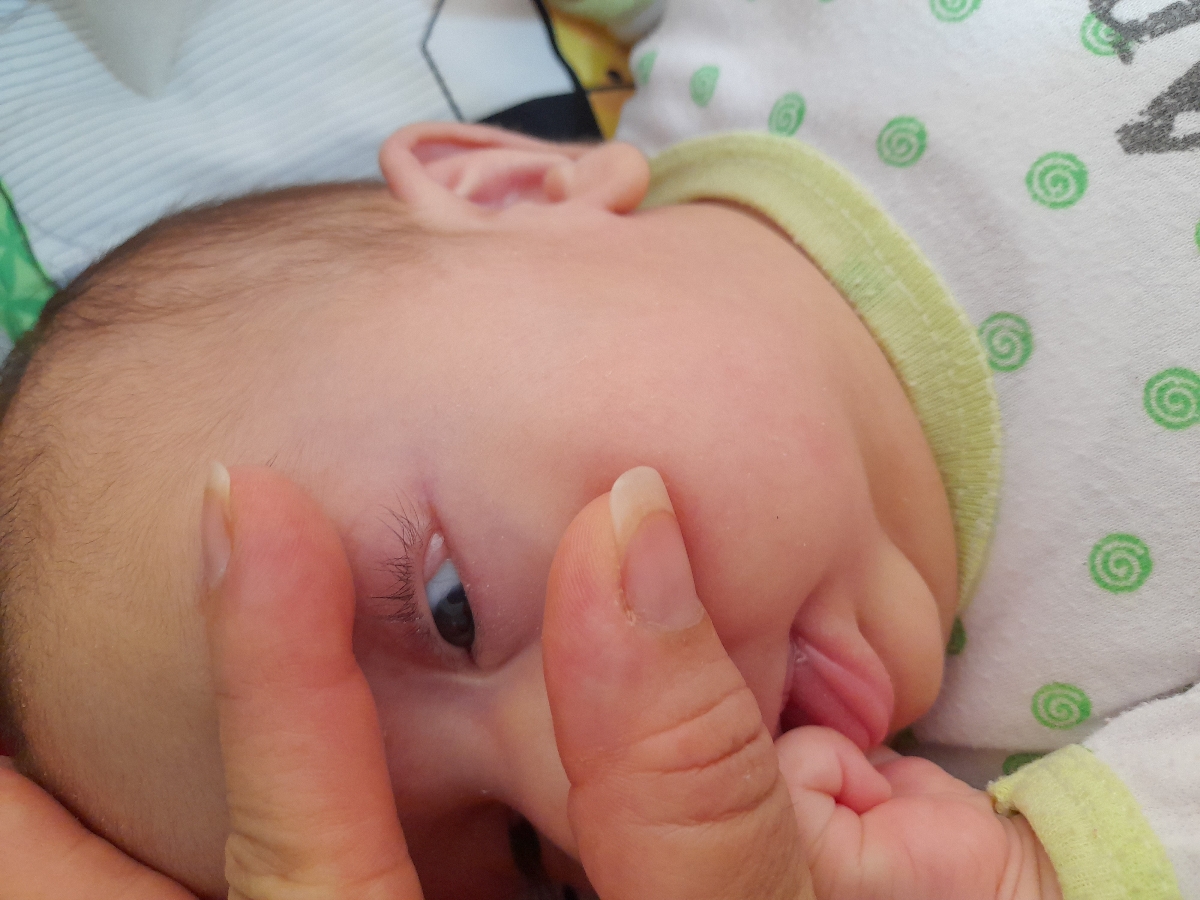 ضایعه ی سفید گوشه چشم