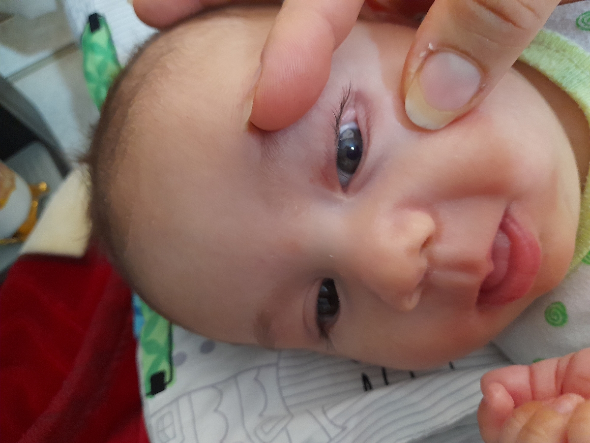 ضایعه ی سفید گوشه چشم