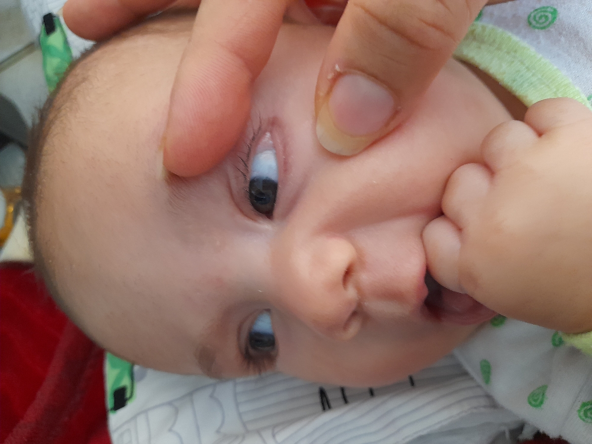 ضایعه ی سفید گوشه چشم