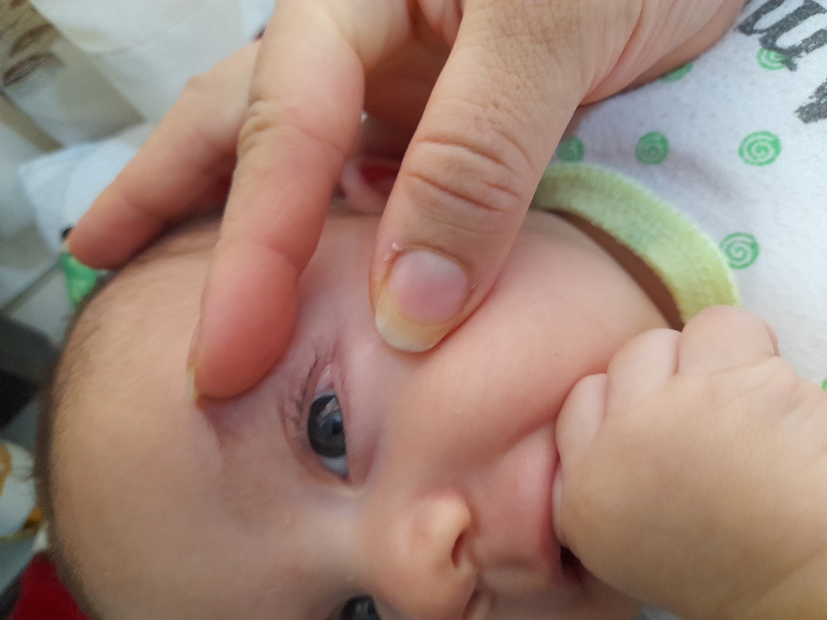 ضایعه ی سفید گوشه چشم