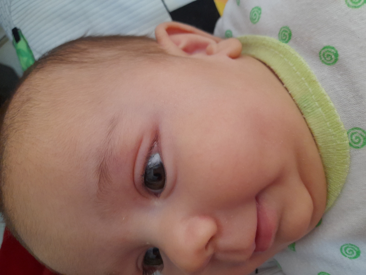 ضایعه ی سفید گوشه چشم