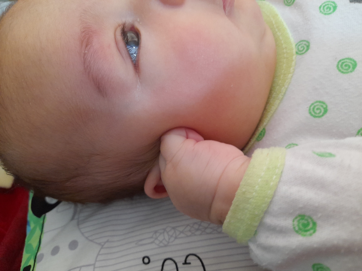 ضایعه ی سفید گوشه چشم