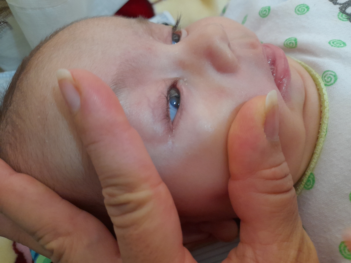 ضایعه ی سفید گوشه چشم