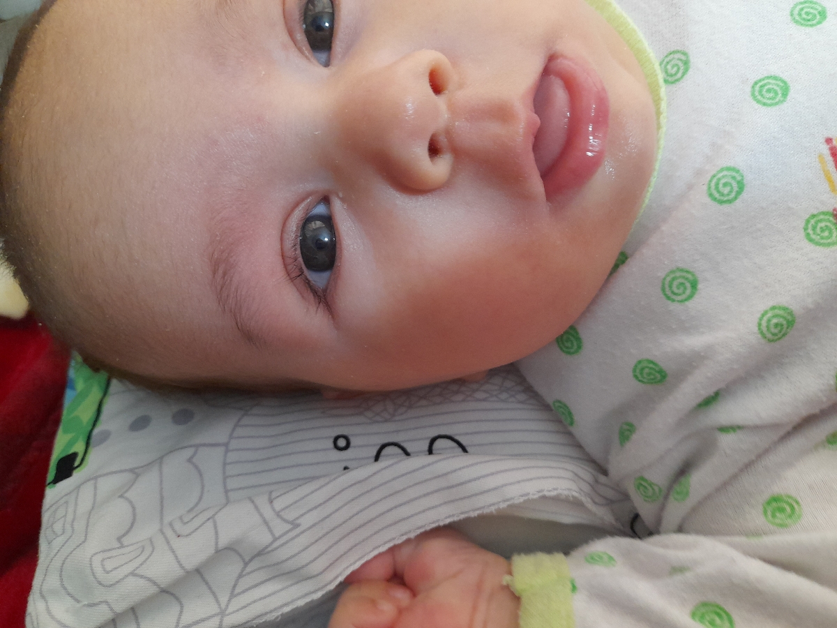 ضایعه ی سفید گوشه چشم