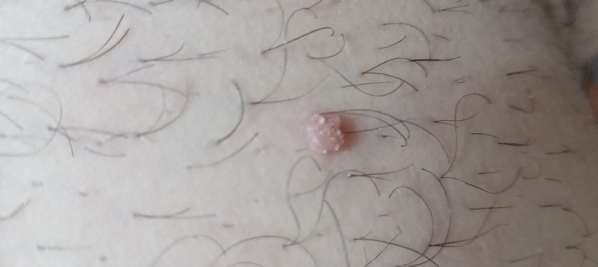 زگیل تناسلی در مردان زگیل تناسلی در مردان