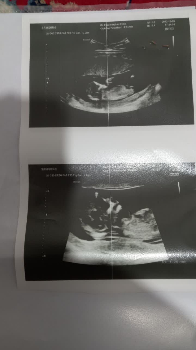 بررسی سونو ان تی و آزمایش غربالگری اول