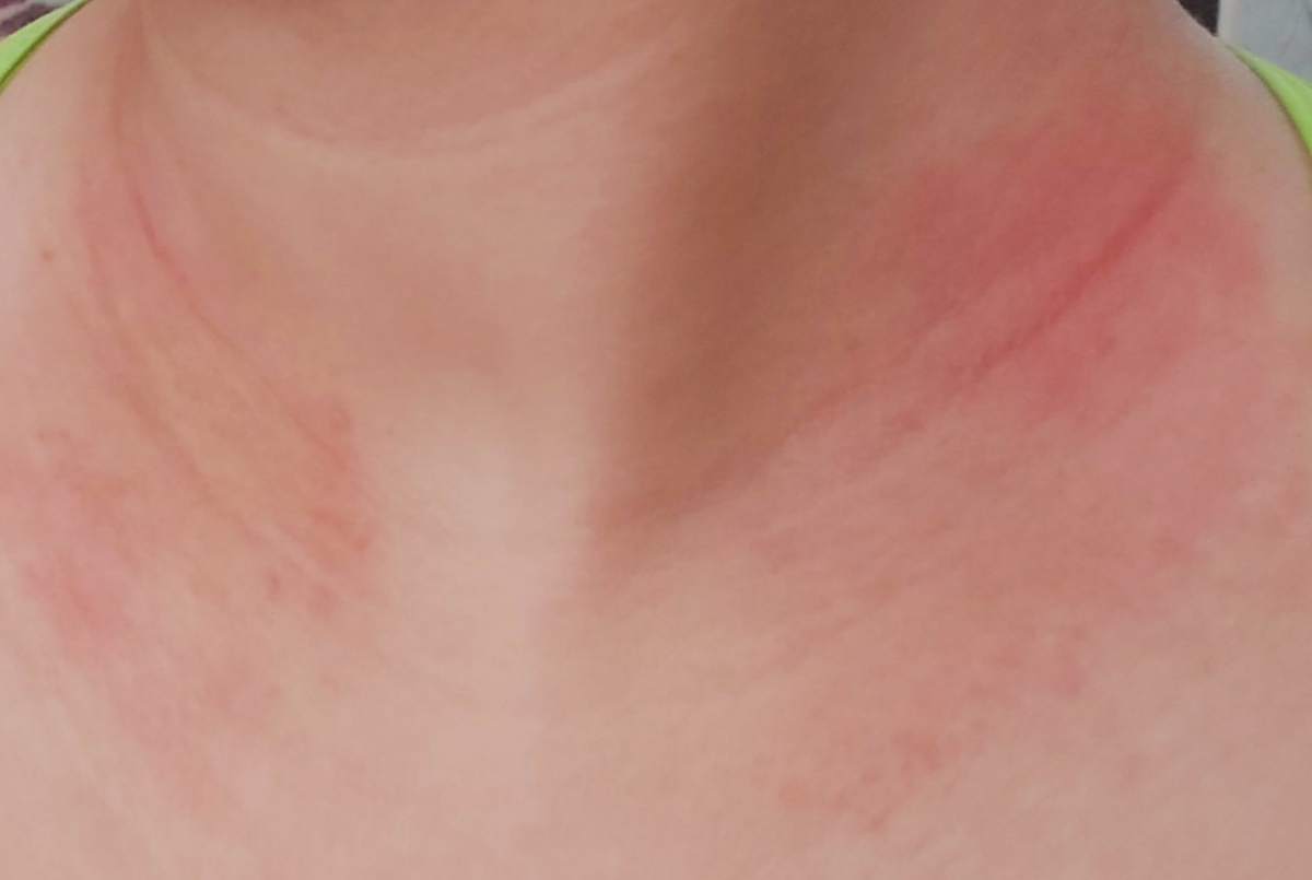 درمان حساسیت پوستی در بارداری درمان حساسیت پوستی در بارداری